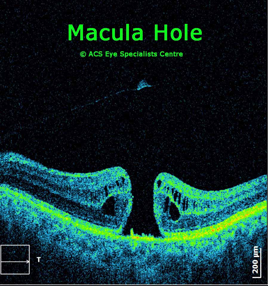 OCT Macula Hole