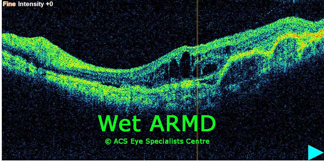 Wet ARMD OCT scan
