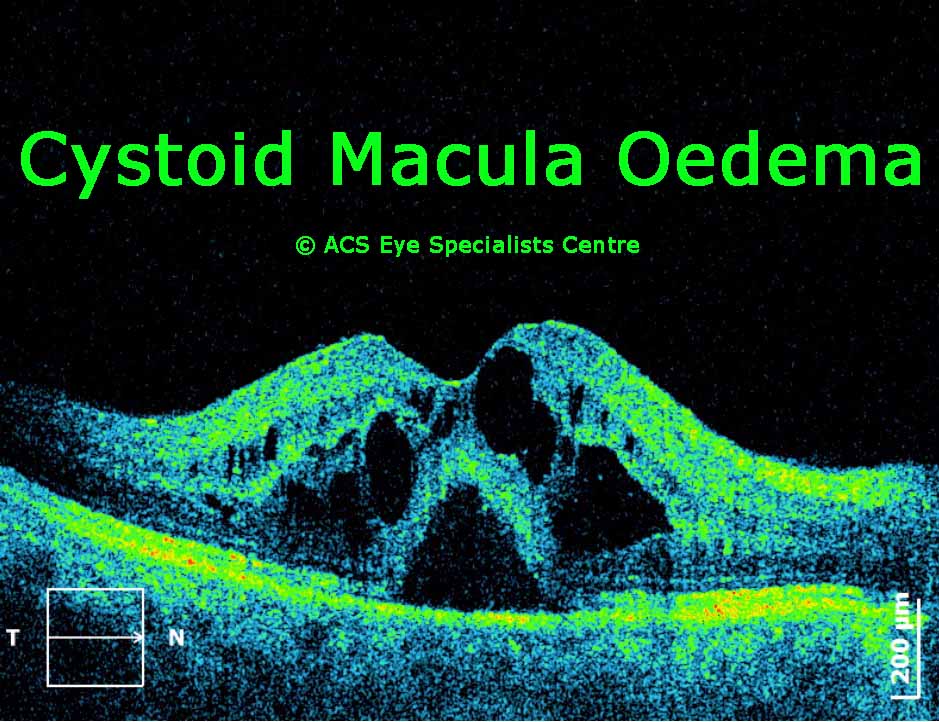 OCT cystoid macula oedema