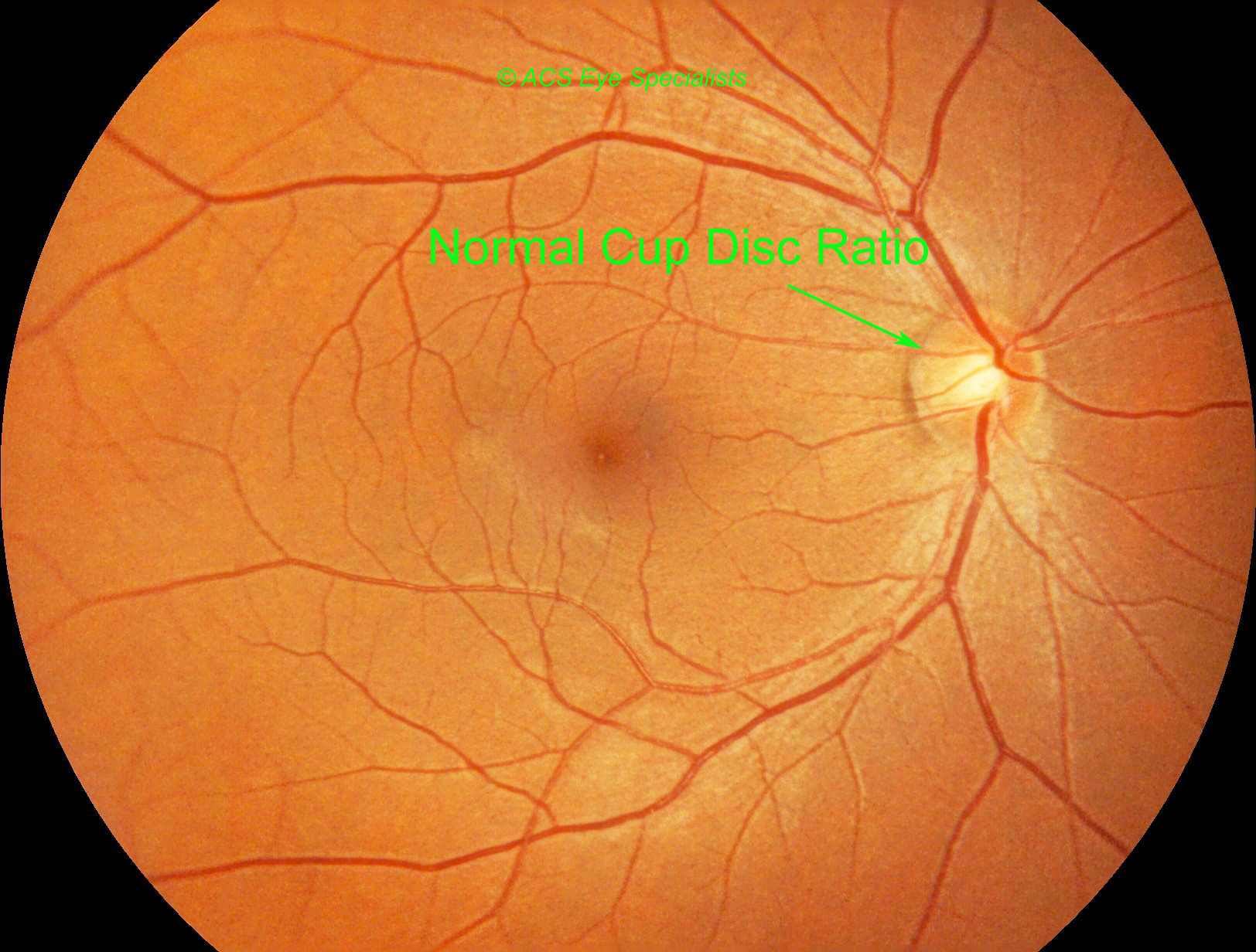 glaucoma normal cup disk ratio