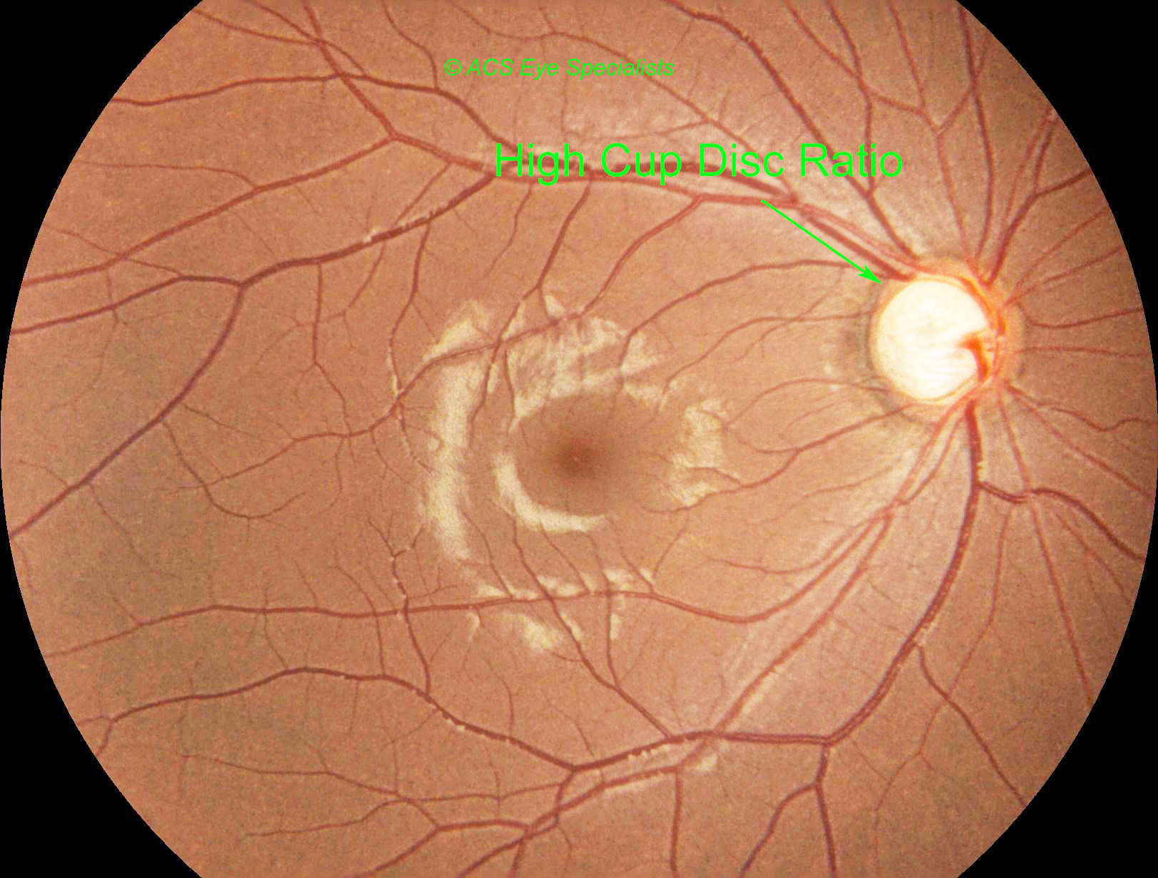 high cup disc ratio glaucoma