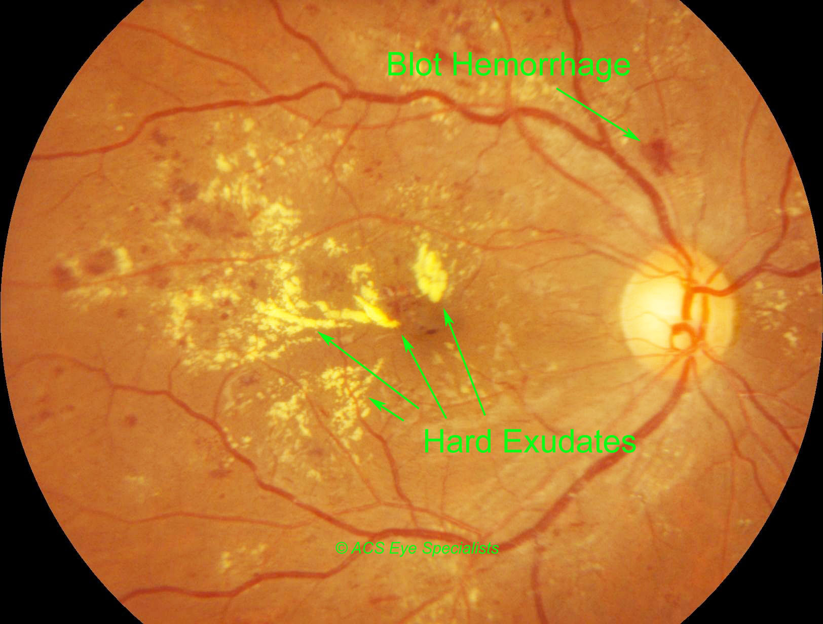 Ретинопатия диабетическая фото глаза